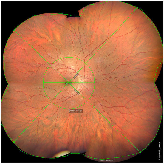 Life | Free Full-Text | Widefield And Ultra-Widefield Retinal Imaging ...