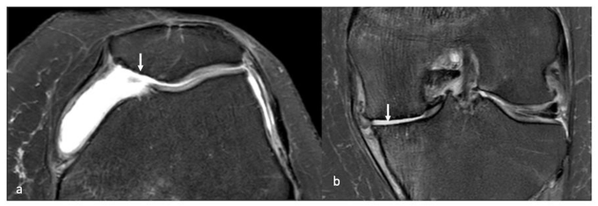 Life Free Full Text Imaging Of Cartilage And Chondral Defects An