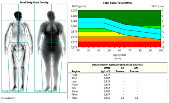 Life | Free Full-Text | Correlation between Bone Mineral Density and ...