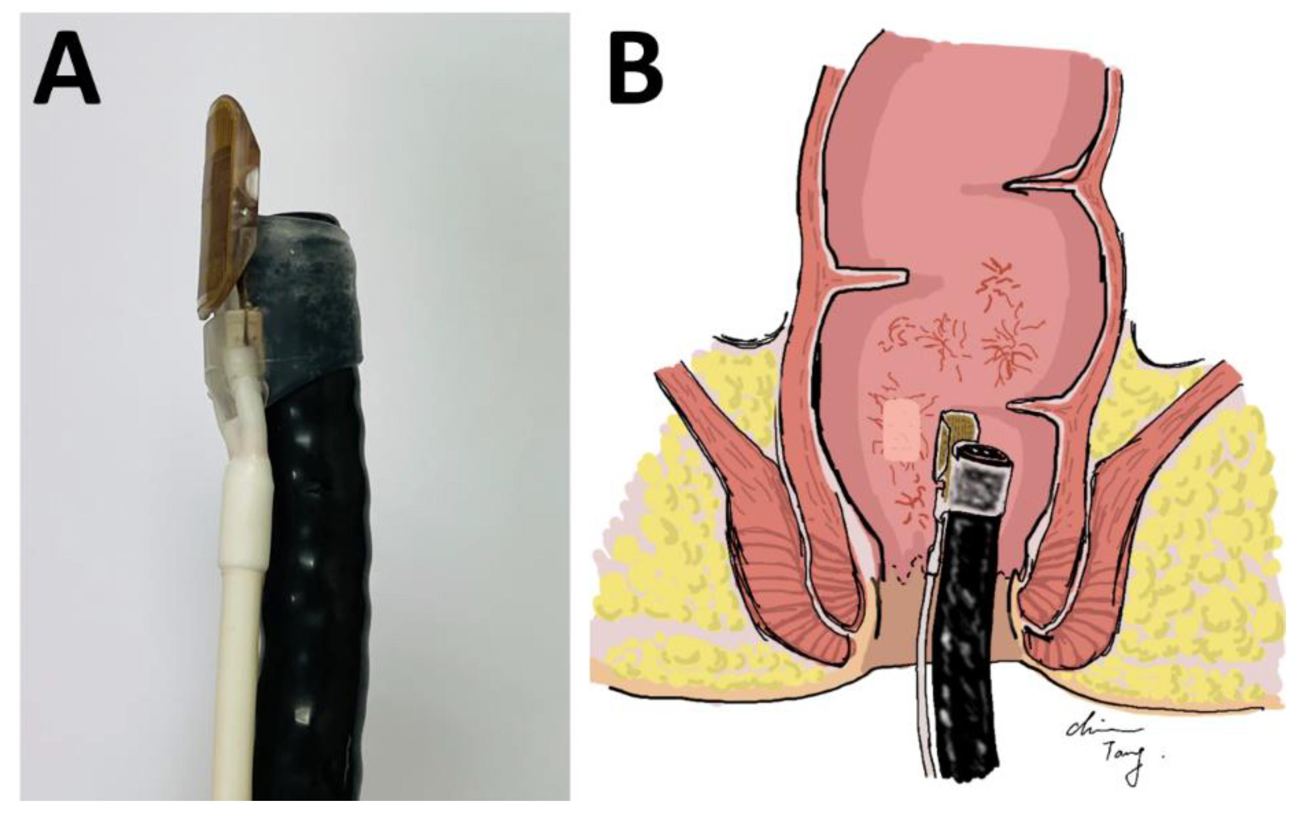 Life | Free Full-Text | A Retrospective Single-Arm Cohort Study in a Single  Center of Radiofrequency Ablation in Treatment of Chronic Radiation  Proctitis