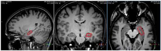 Life Free Full Text Hippocampal Metabolic Alterations in