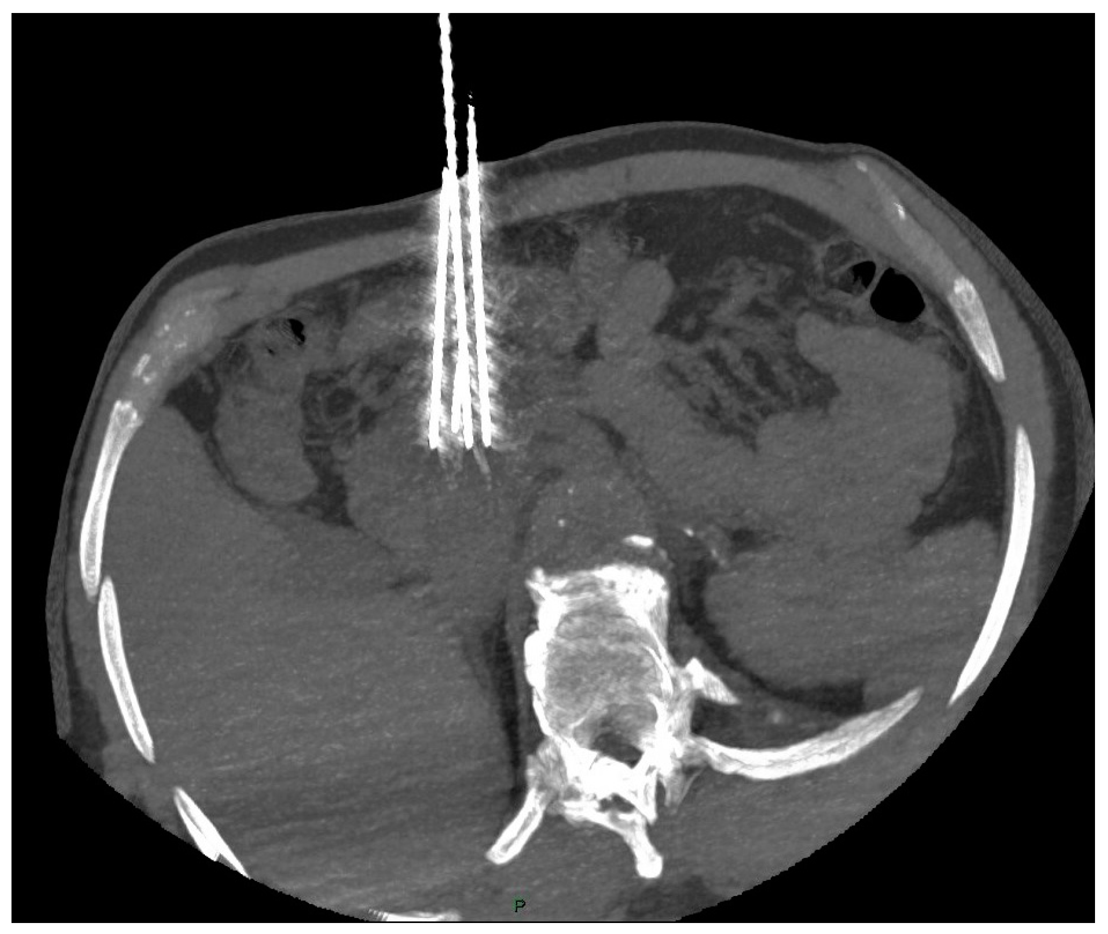 Life Free Full Text Interventional Radiology in the Treatment