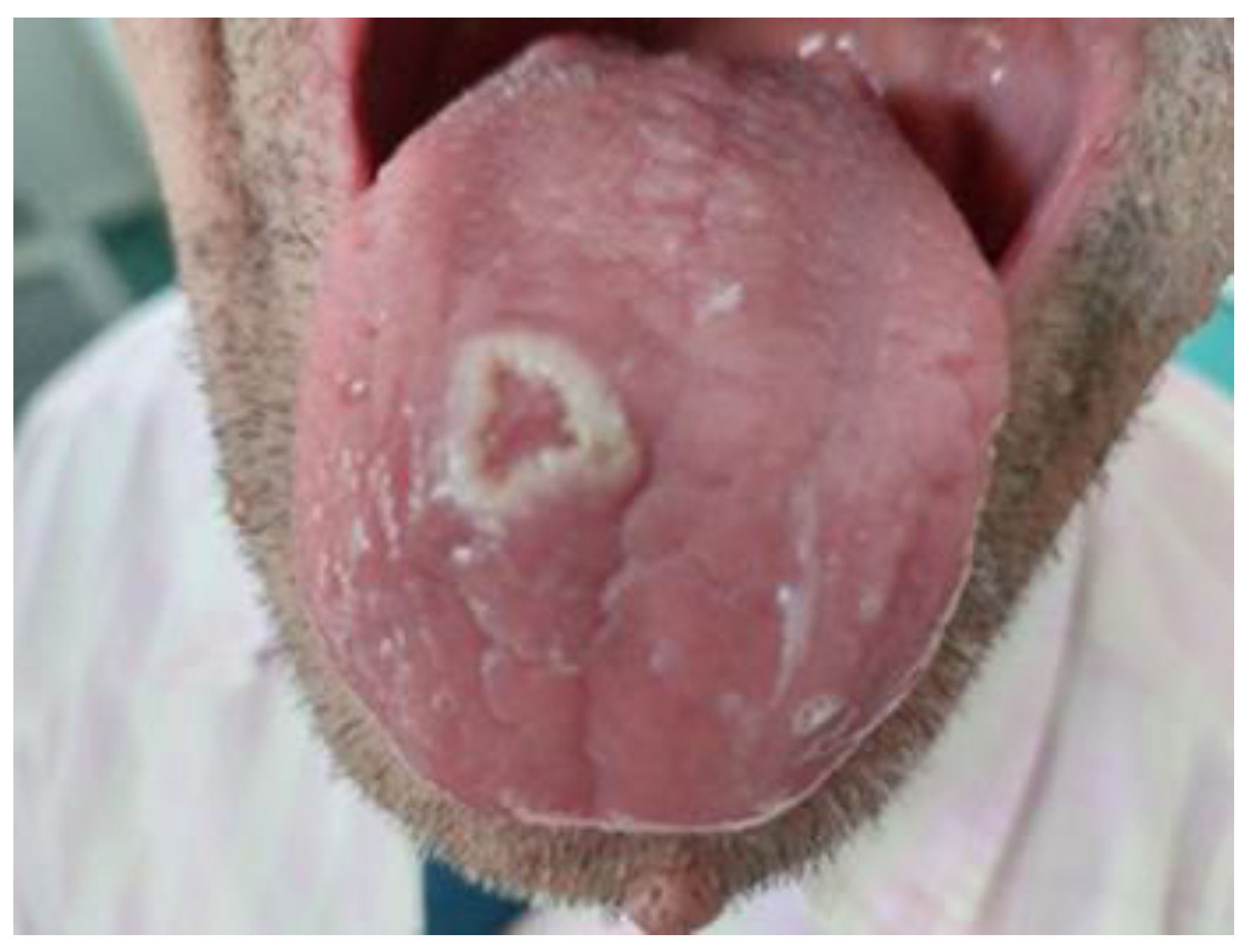 hiv tongue