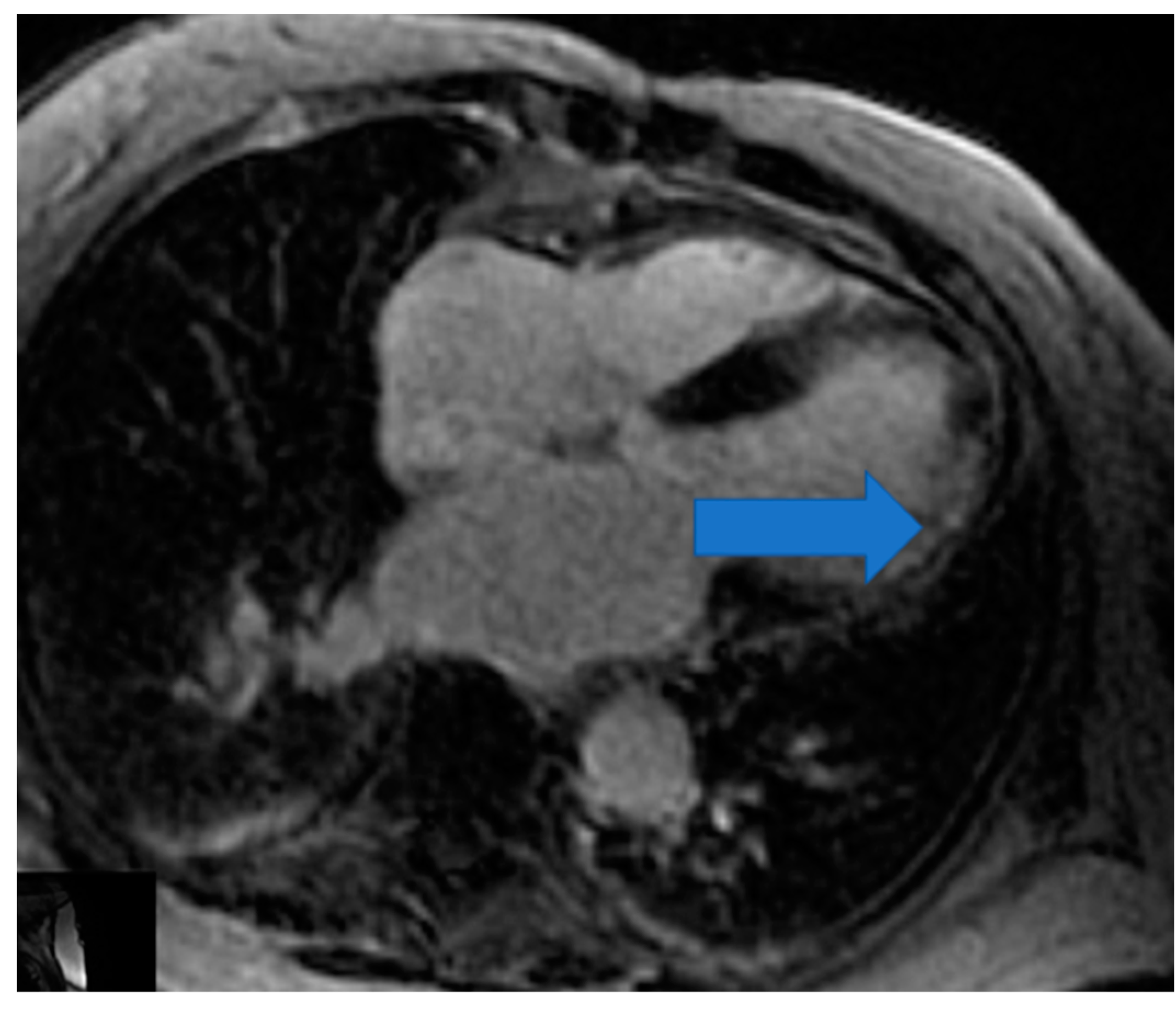 Rheumatoid Arthritis and Left Ventricular Systolic Dysfunction - Advances  in RA, PsO, PsA, and Related Disorders