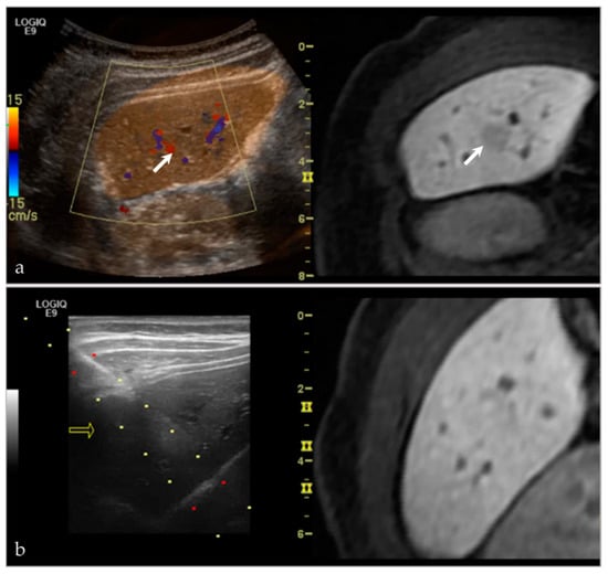 Life | Free Full-Text | Ultrasound Fusion: Applications in ...