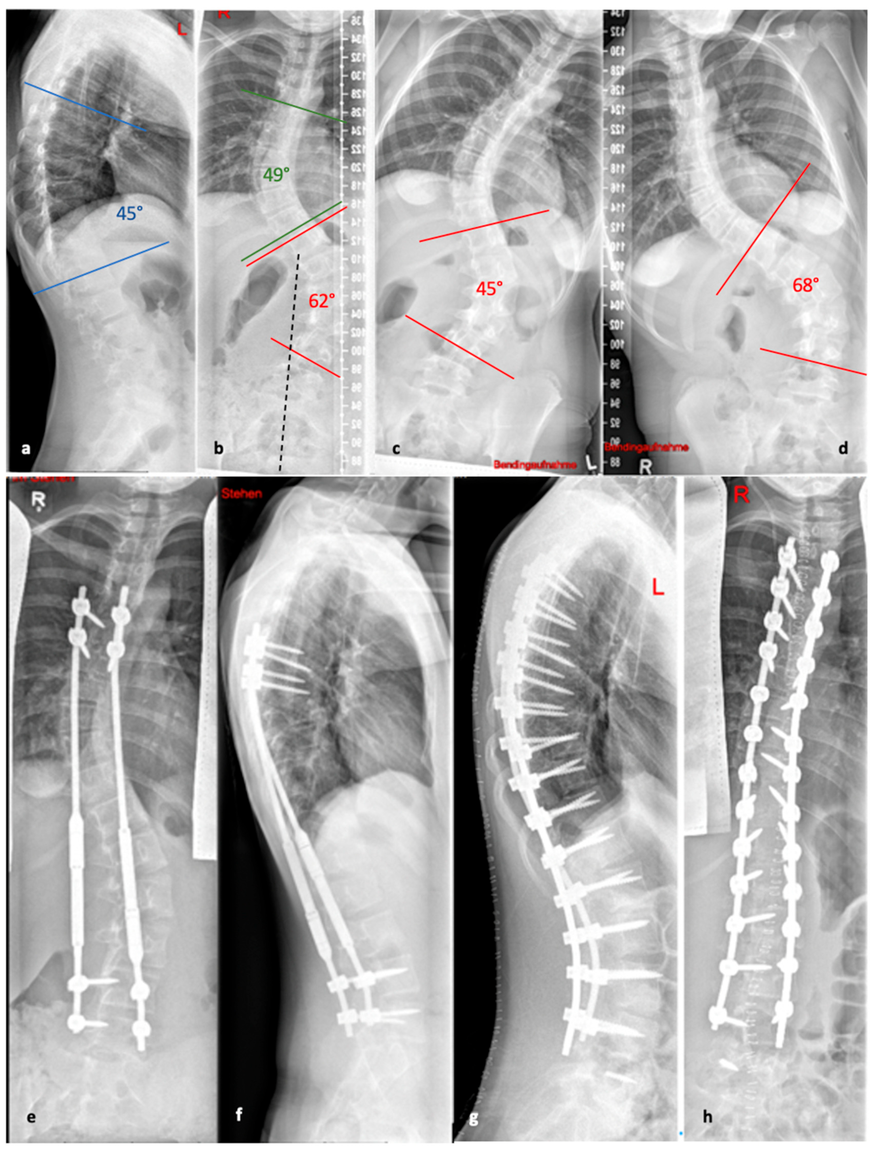 Life | Free Full-Text | Surgical Treatment of Spinal Deformities in  Pediatric Orthopedic Patients