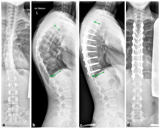 Spinal brace (orthosis) after thoracoplasty surgery