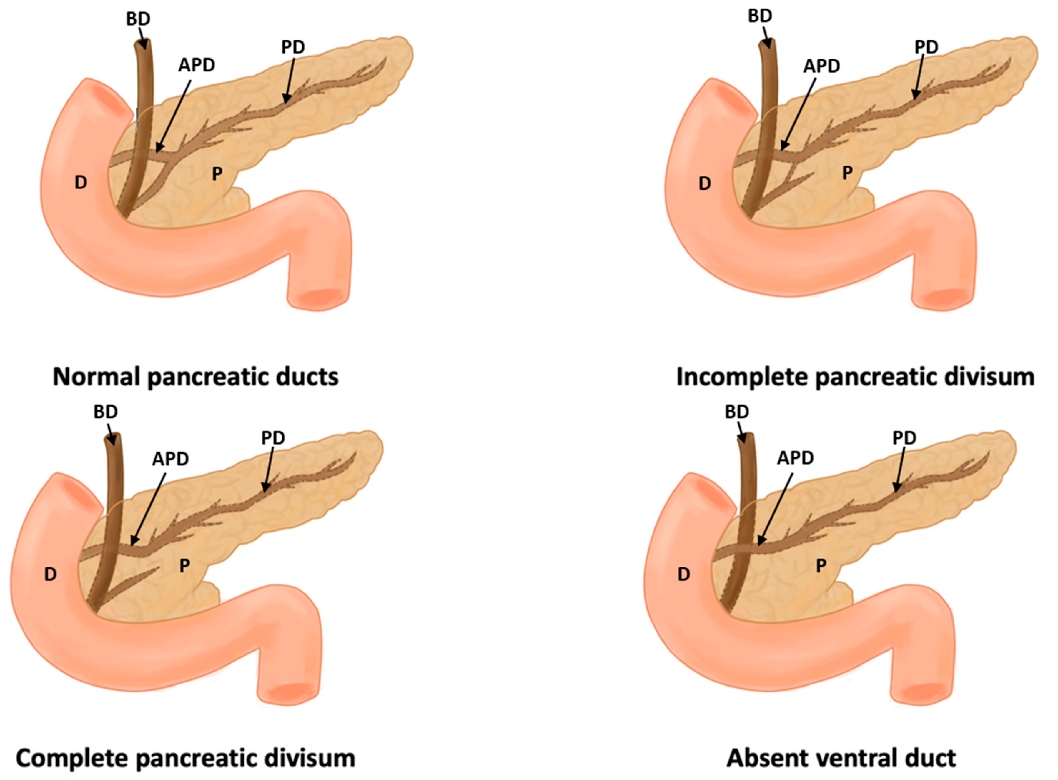 annular pancreas embryology