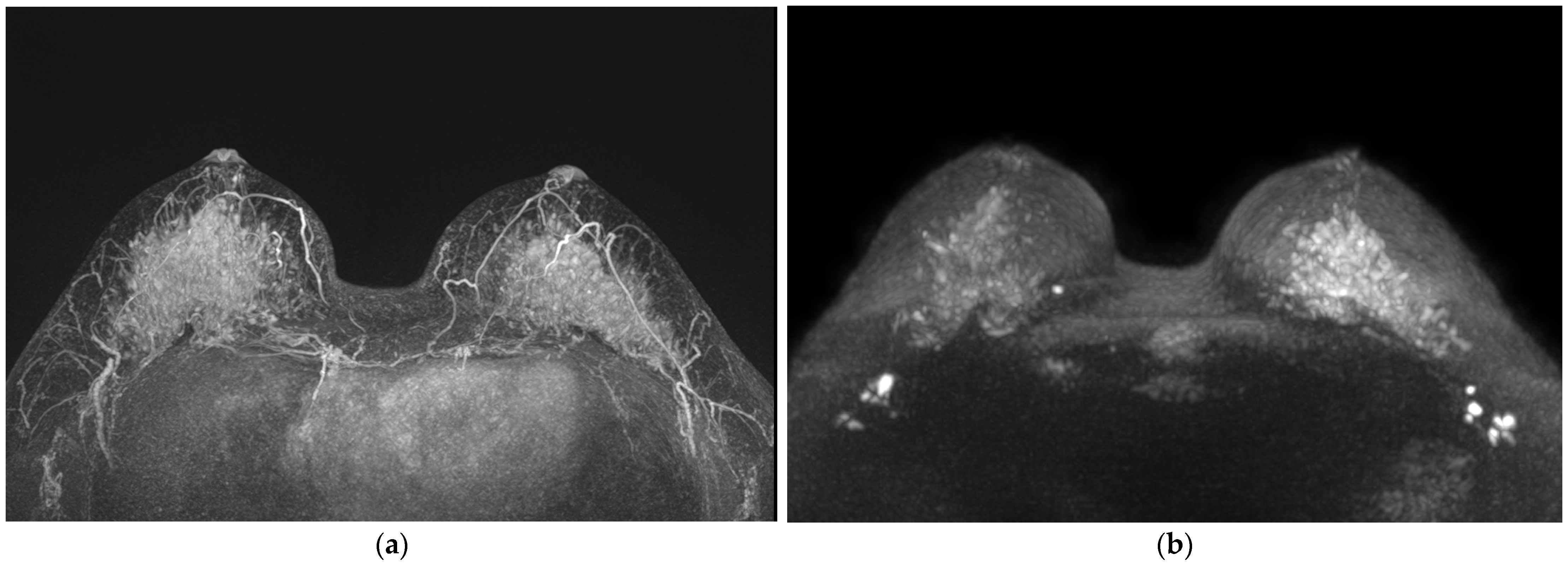 Diffusion-weighted imaging of breast begins to come of age