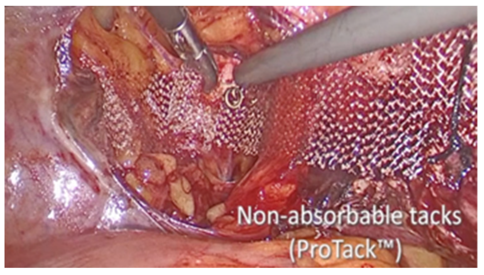 Laparoscopic Non-Mesh Cerclage Pectopexy for Pelvic Organ Prolapse