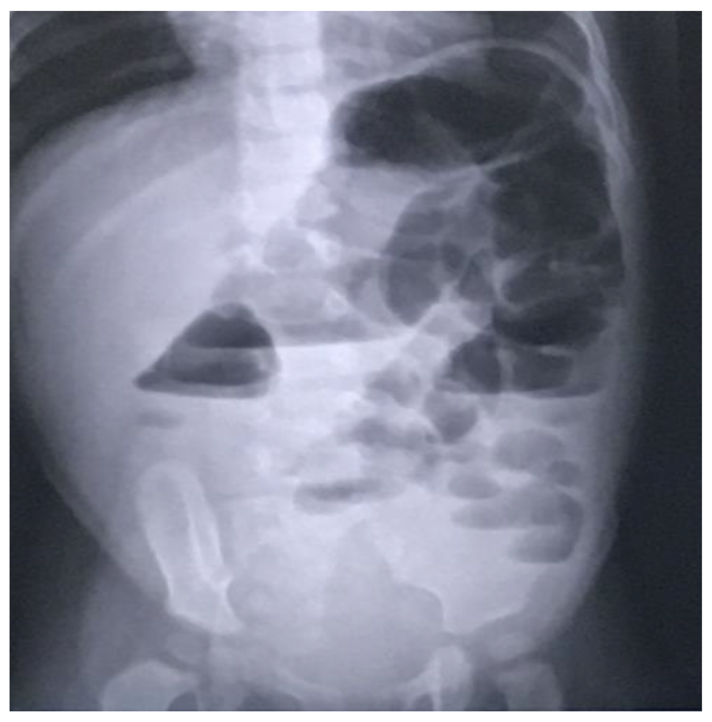 Plain X ray of a young girl with two stones in situ. (a). Stone in