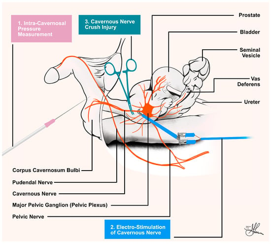 PUDENDAL NERVE NEUROPATHY - Innovative Therapy Canada