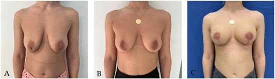 Breast Augmentation for Uneven Breasts, Dr. Alderman