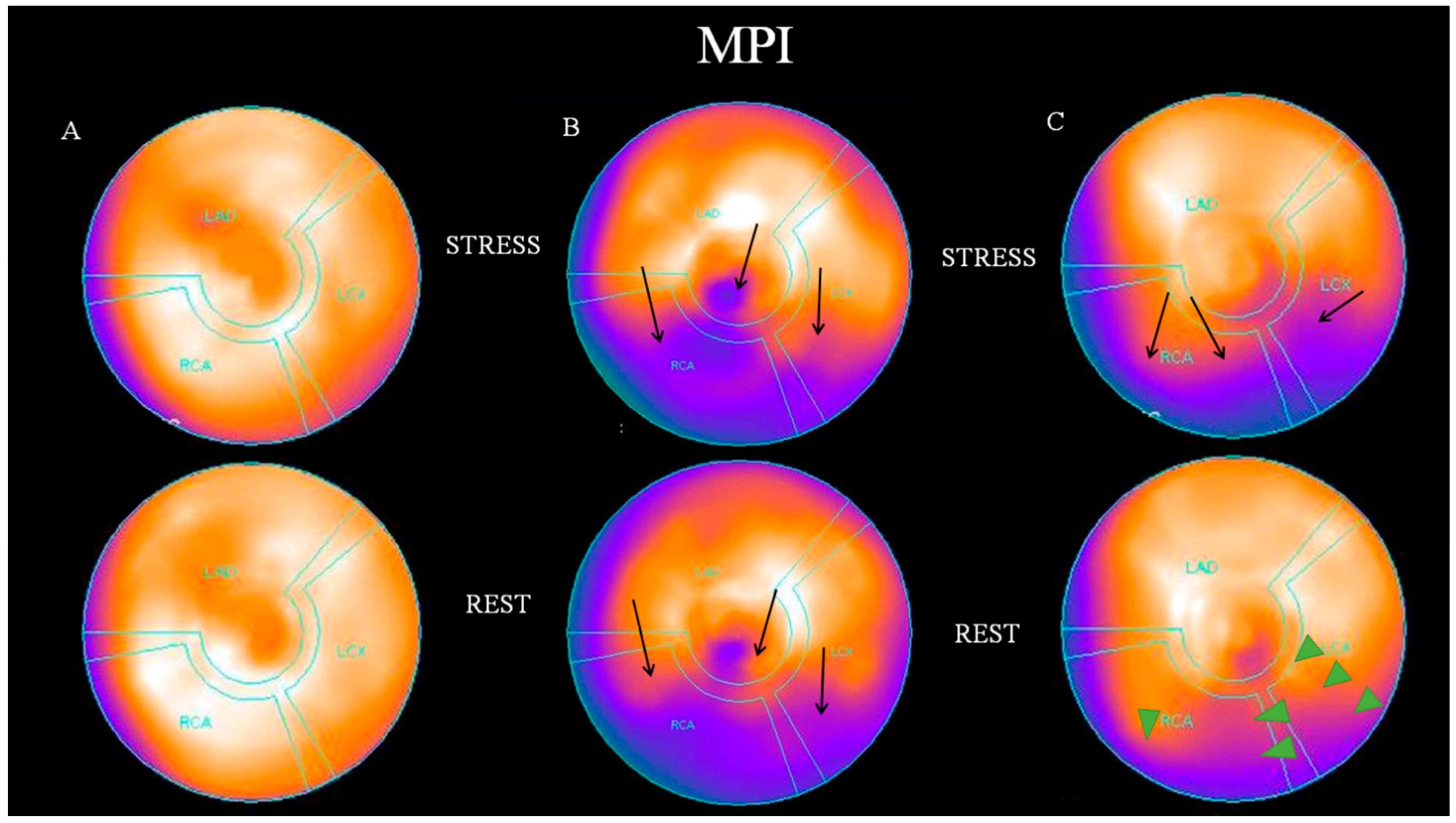 Procalcitonin to C-reactive protein ratio is associated with short-term  mortality in ischemic stroke patients: preliminary report