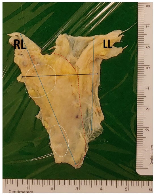 Lymphatics | Free Full-Text | The Postmortem Evaluation of Anatomical ...