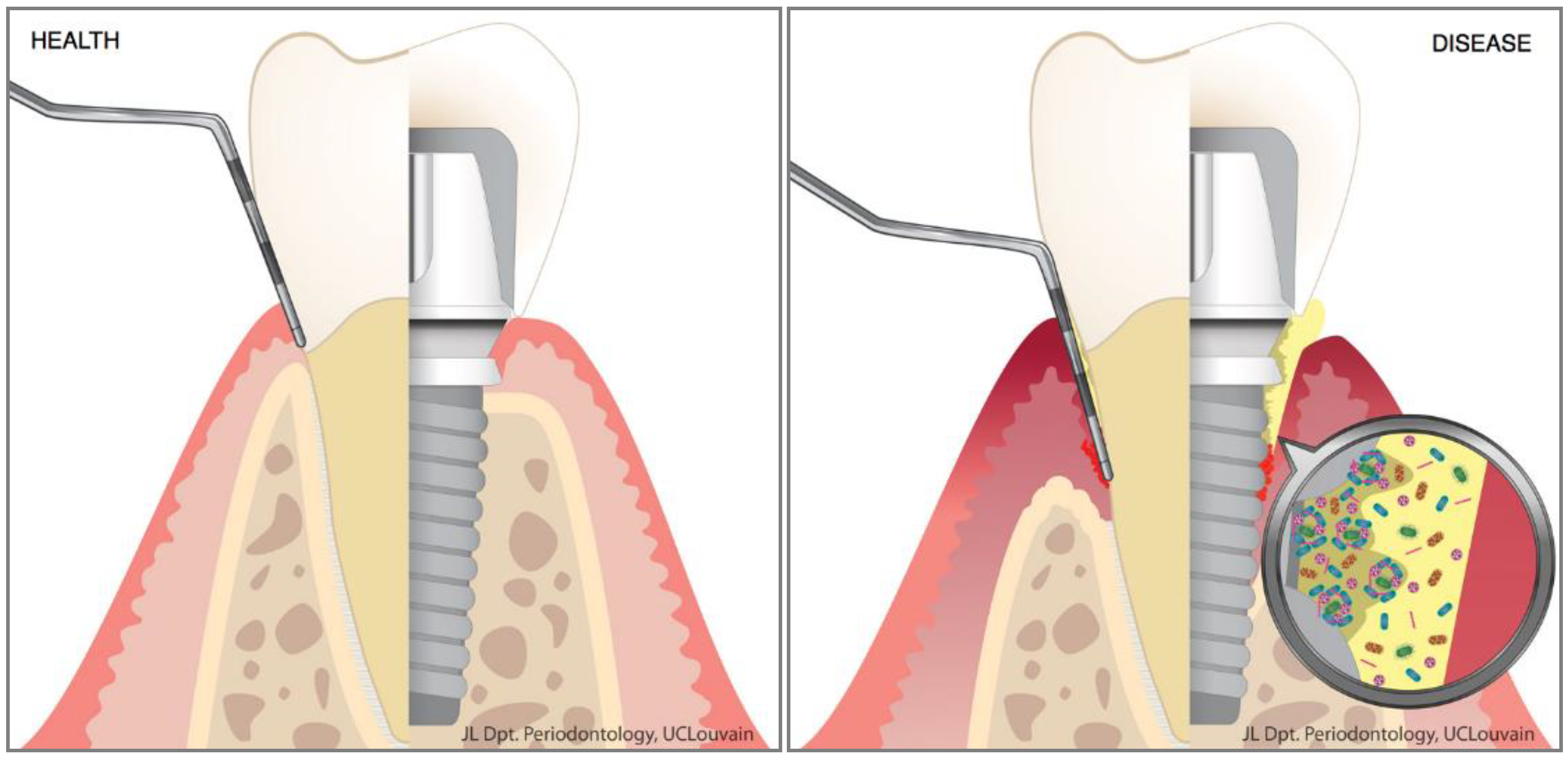 Materials Free Full Text Oral Microbes Biofilms And Their Role In Periodontal And Peri