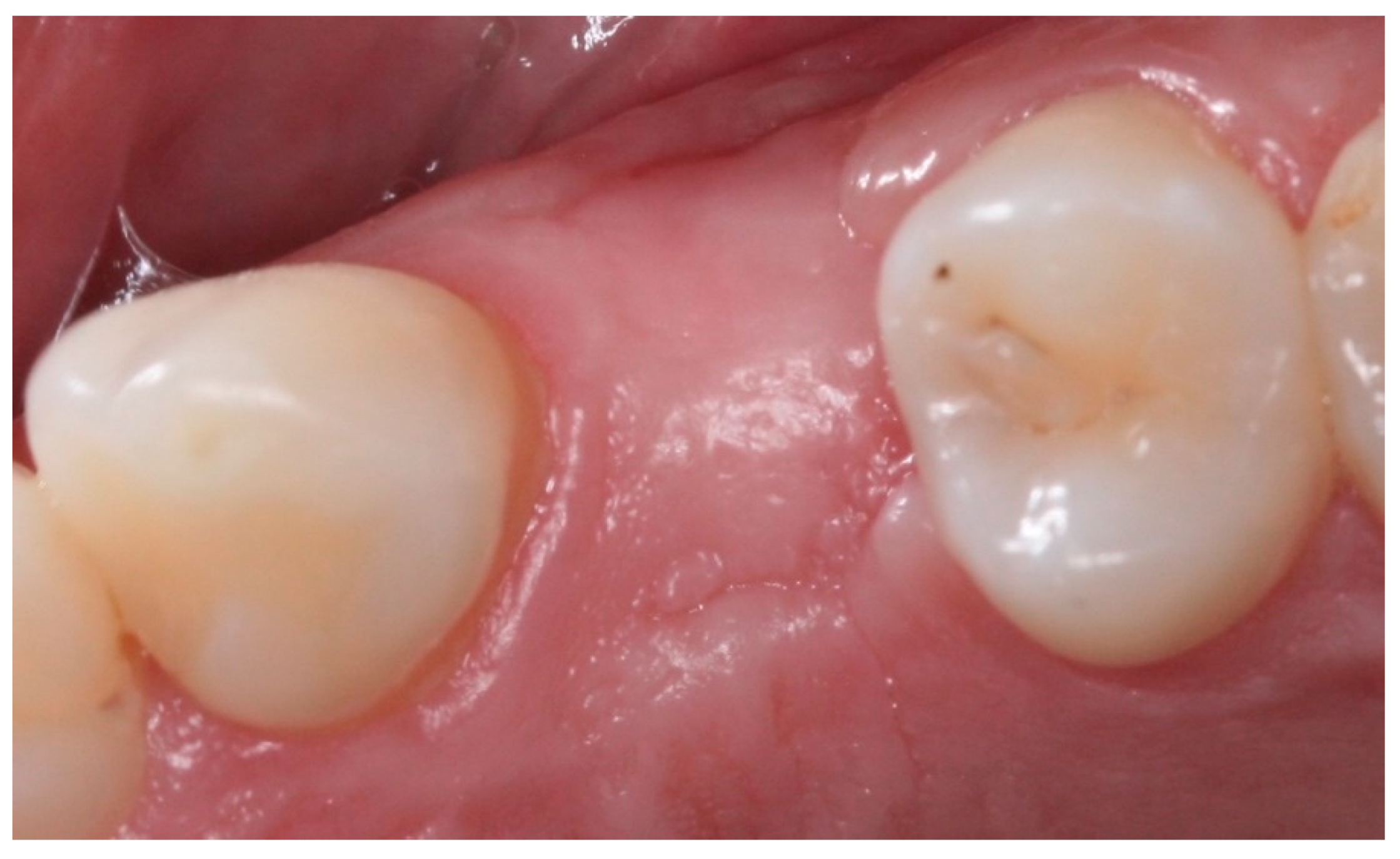 Materials | Free Full-Text | Socket Preservation Using a (Dense) PTFE ...