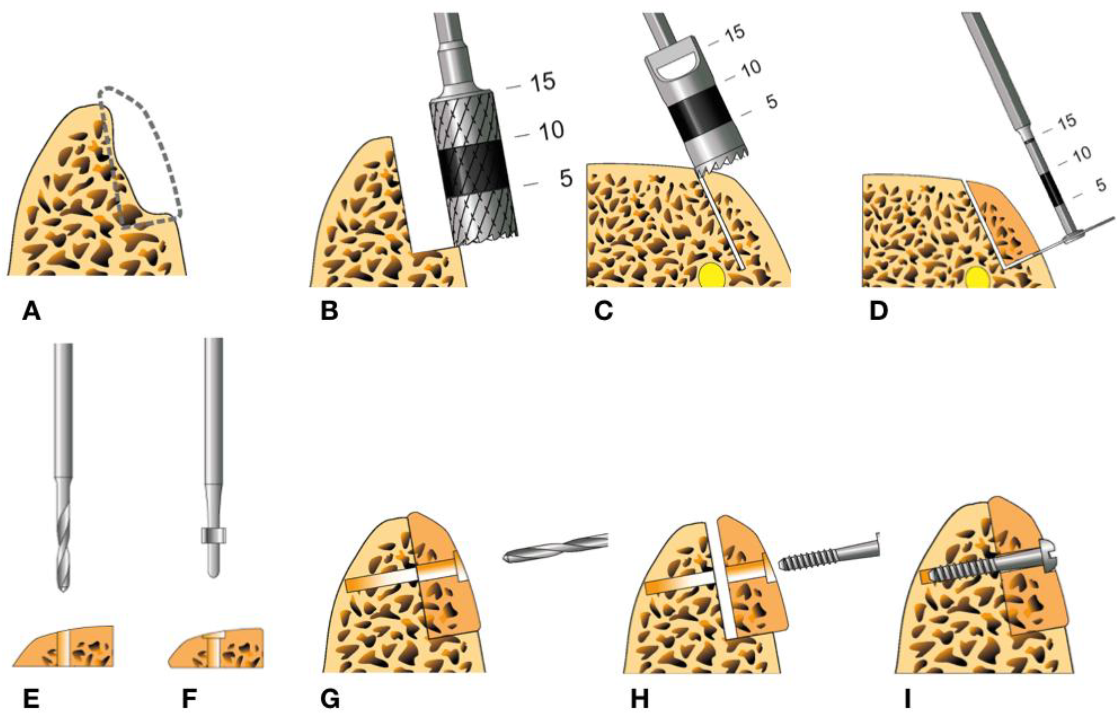 AUTOGENOUS BONE HARVESTING TREPHINE KIT