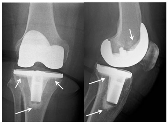 Materials Free Full Text Pmma Based Bone Cements And The Problem Of Joint Arthroplasty Infections Status And New Perspectives Html