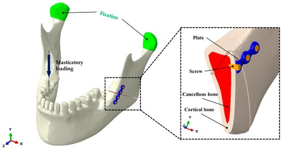 Materials Free Full Text The Stability Of Hydroxyapatite Poly L Lactide Fixation For Unilateral Angle Fracture Of The Mandible Assessed Using A Finite Element Analysis Model Html