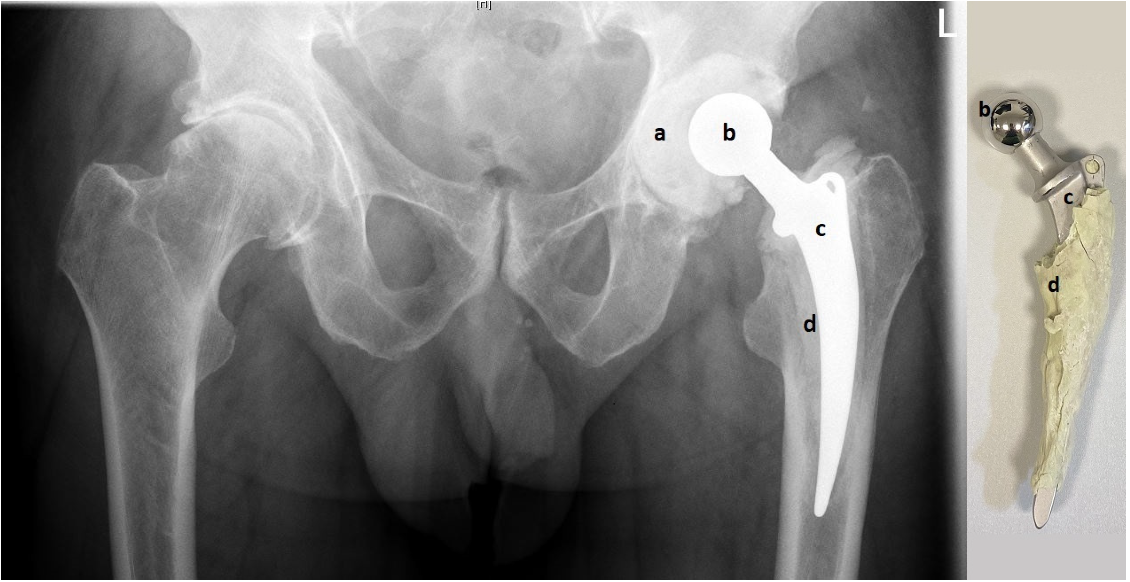 Articulating Spacers for the Treatment of Infected Total Knee