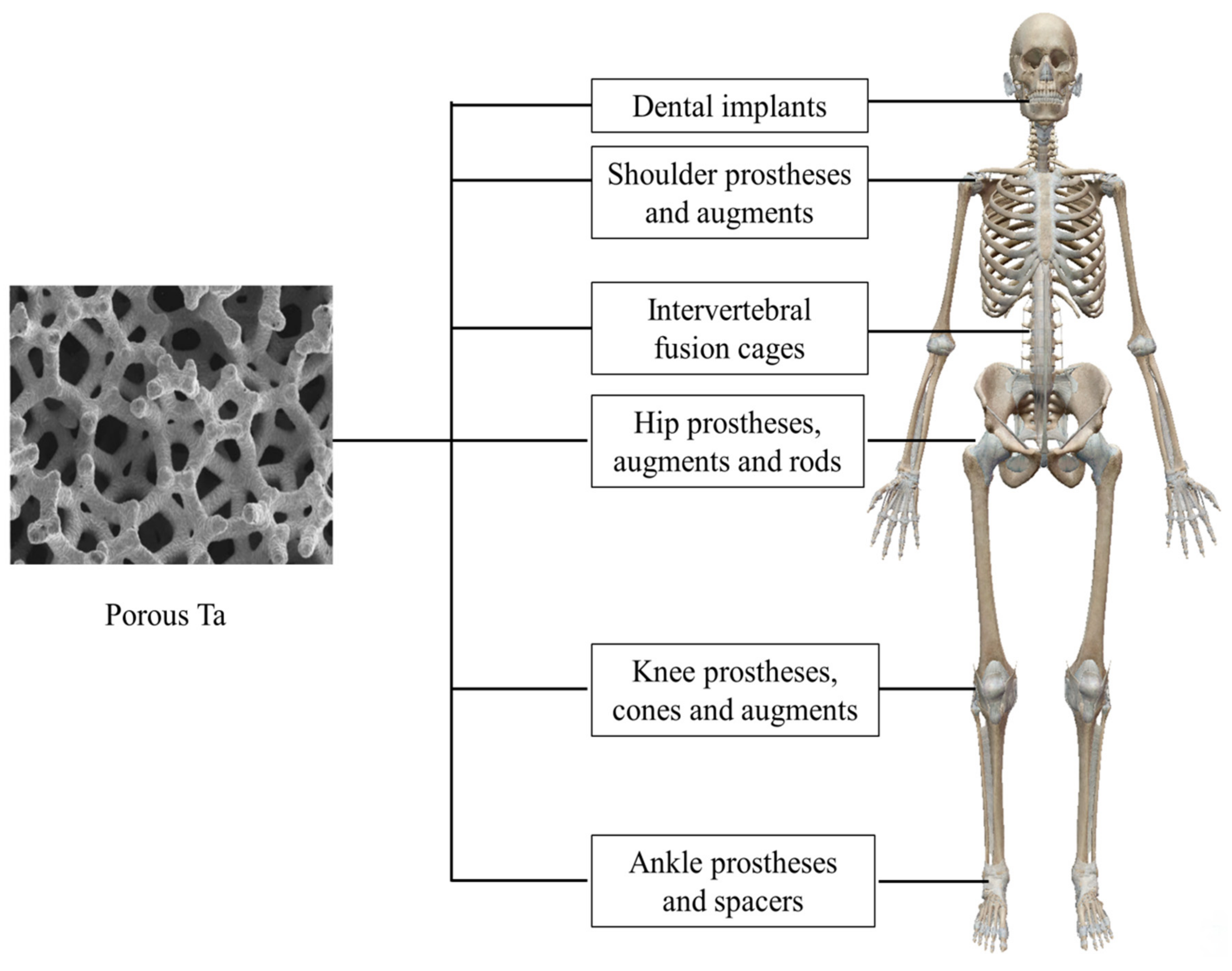 Materials | Free Full-Text | The Clinical Application of Porous Tantalum  and Its New Development for Bone Tissue Engineering | HTML