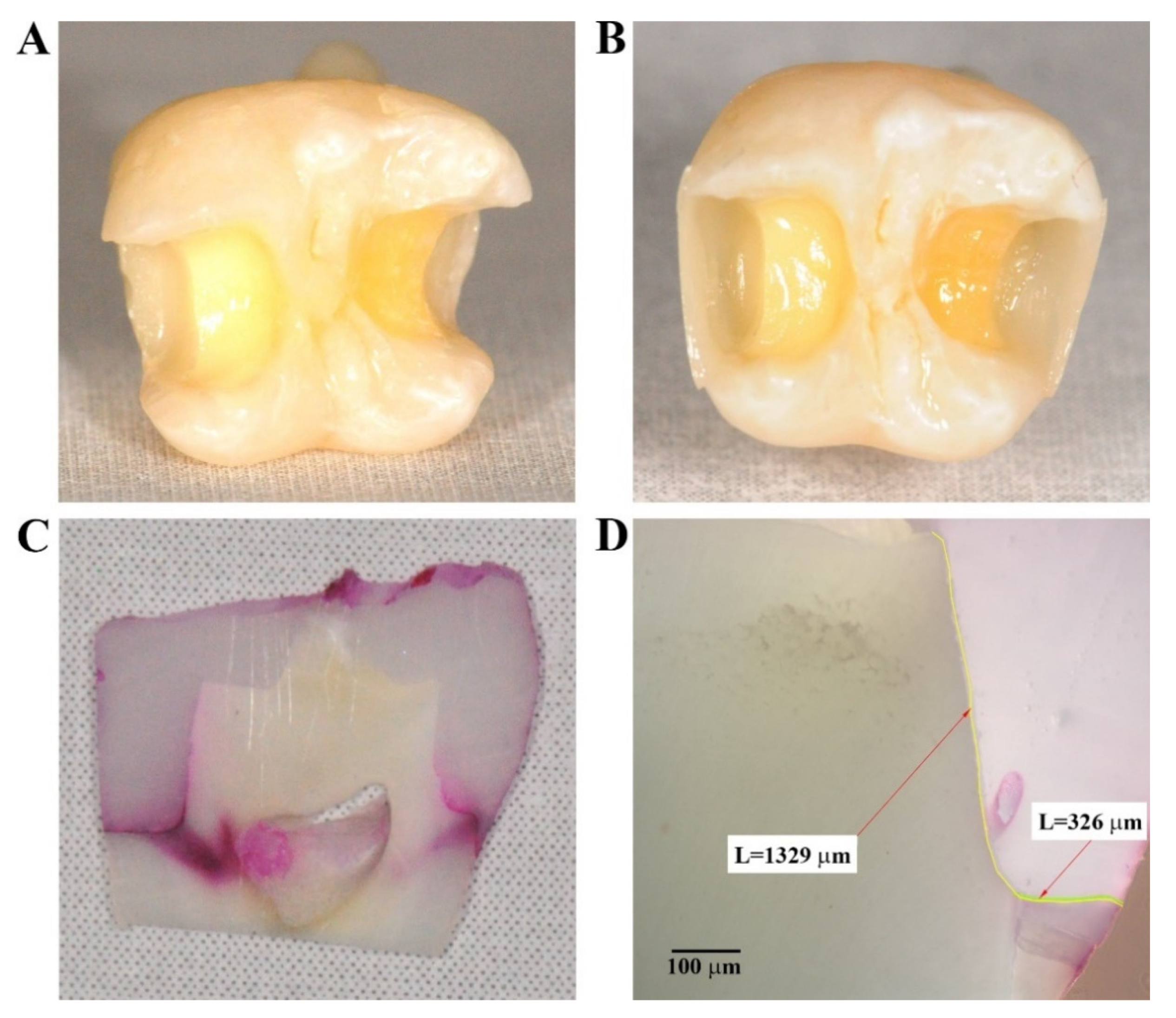Materials | Free Full-Text | In Vitro Study on the Adhesive Performance of  Some Resin-Based Materials Used to Restore Class II Cavities