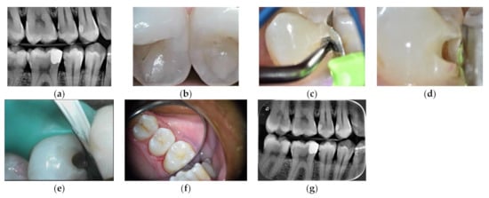 Dental restoration material - Attack Gel - Biodinâmica - gel