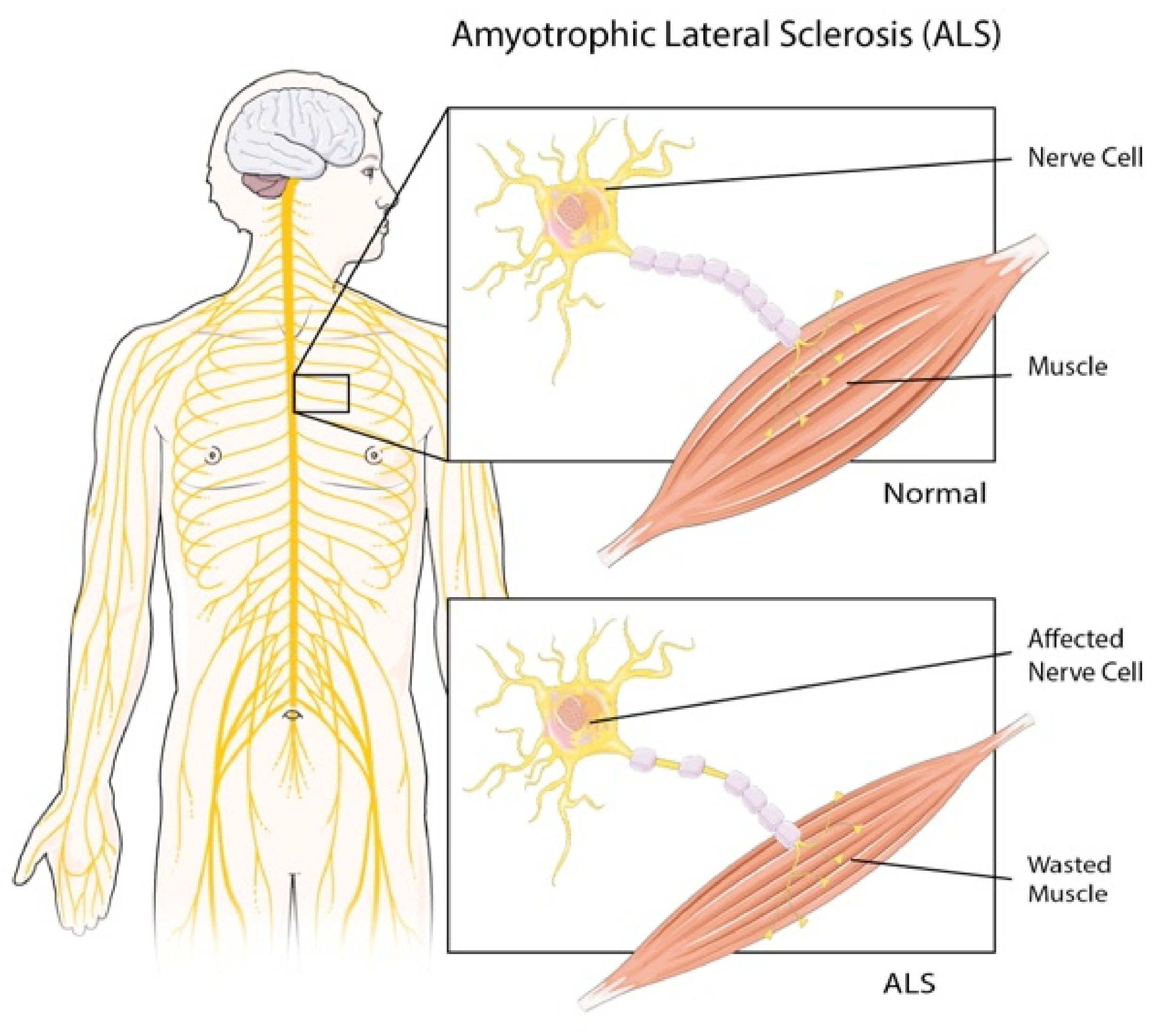 What to Know About Amyotrophic Lateral Sclerosis (ALS)