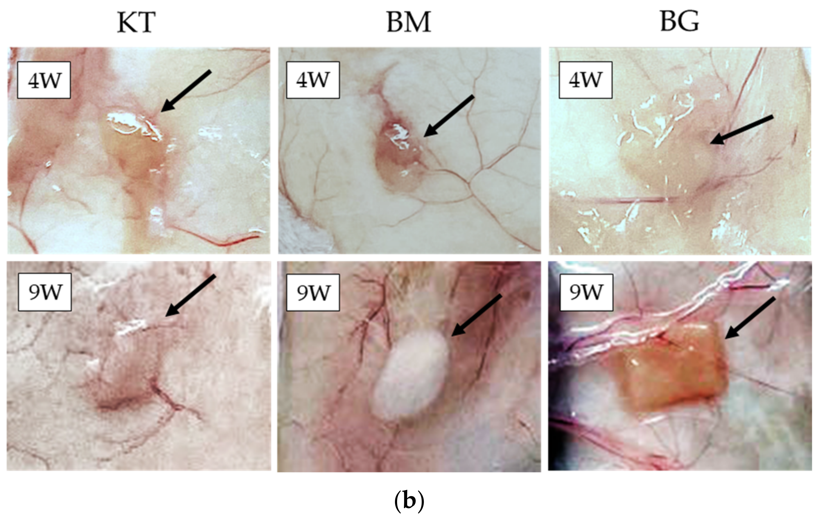 Laparoscopic pictures of the fibrinous adhesion, dark brownish ascetic