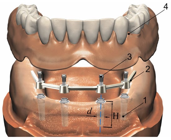 Biomechanical comparison of different prosthetic materials and posterior  implant angles in all-on-4 treatment concept by three-dimensional finite  element analysis