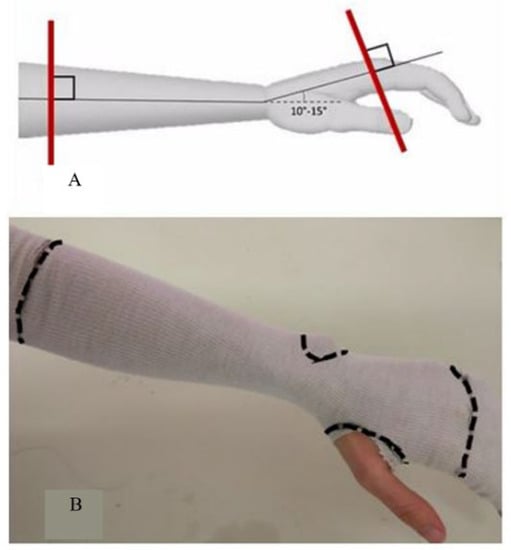 Materials | Free Full-Text | 3D-Printed Patient-Specific Casts for the ...