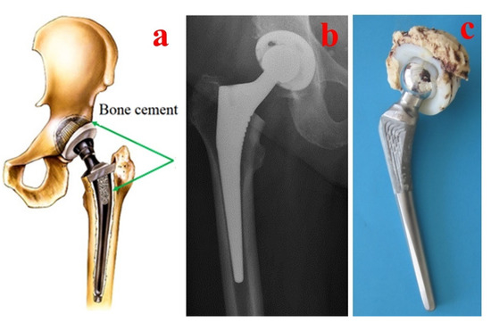 Plate osteosynthesis combined with bone cement provides the