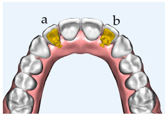 Customized Ligature Hook: A Noble Approach for Engaging Elastic in Fixed  Orthodontics