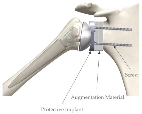 When to Use Form-Stable (Anatomic) Implants - Phase Plastic Surgery