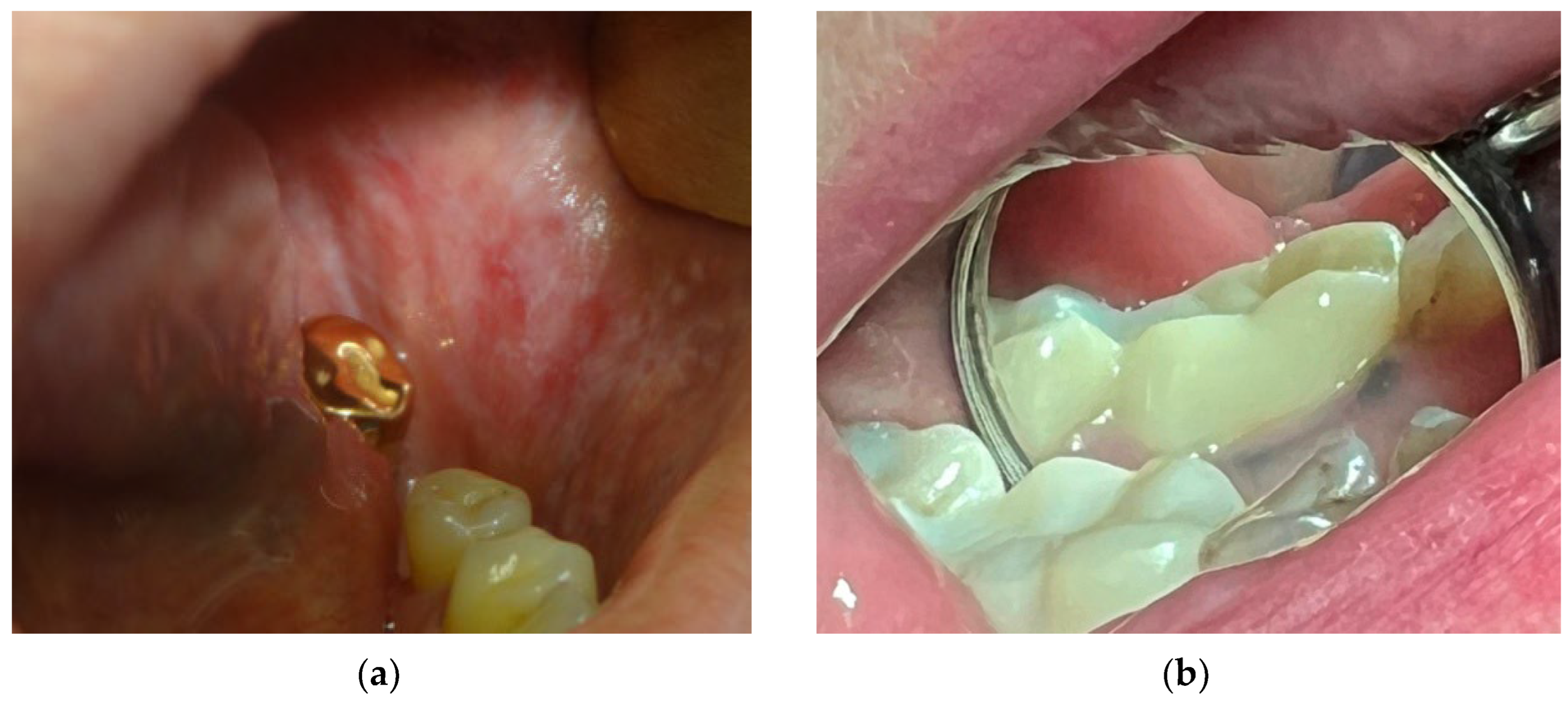 An Overview of Amalgam Tattoos for the Dental Hygienist - Today's RDH
