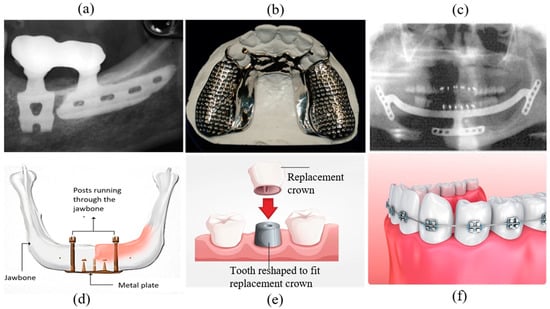 Why Dental Implants Are Better Than Other Tooth Repair » St. Louis