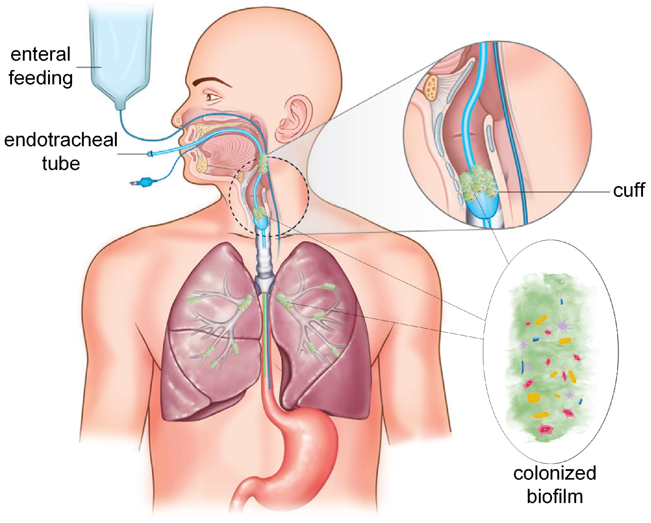 Materials | Free Full-Text | Antimicrobial Solutions for Endotracheal Tubes  in Prevention of Ventilator-Associated Pneumonia