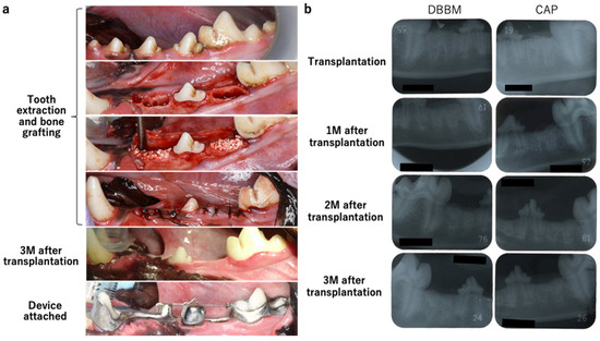 Cureus, A New Approach for Explaining and Treating Dry Sockets: A Pilot  Retrospective Study