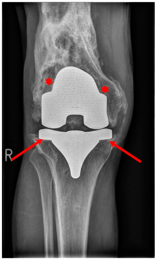 Younger knee replacement patients more likely to require reoperation than  those 60 and older