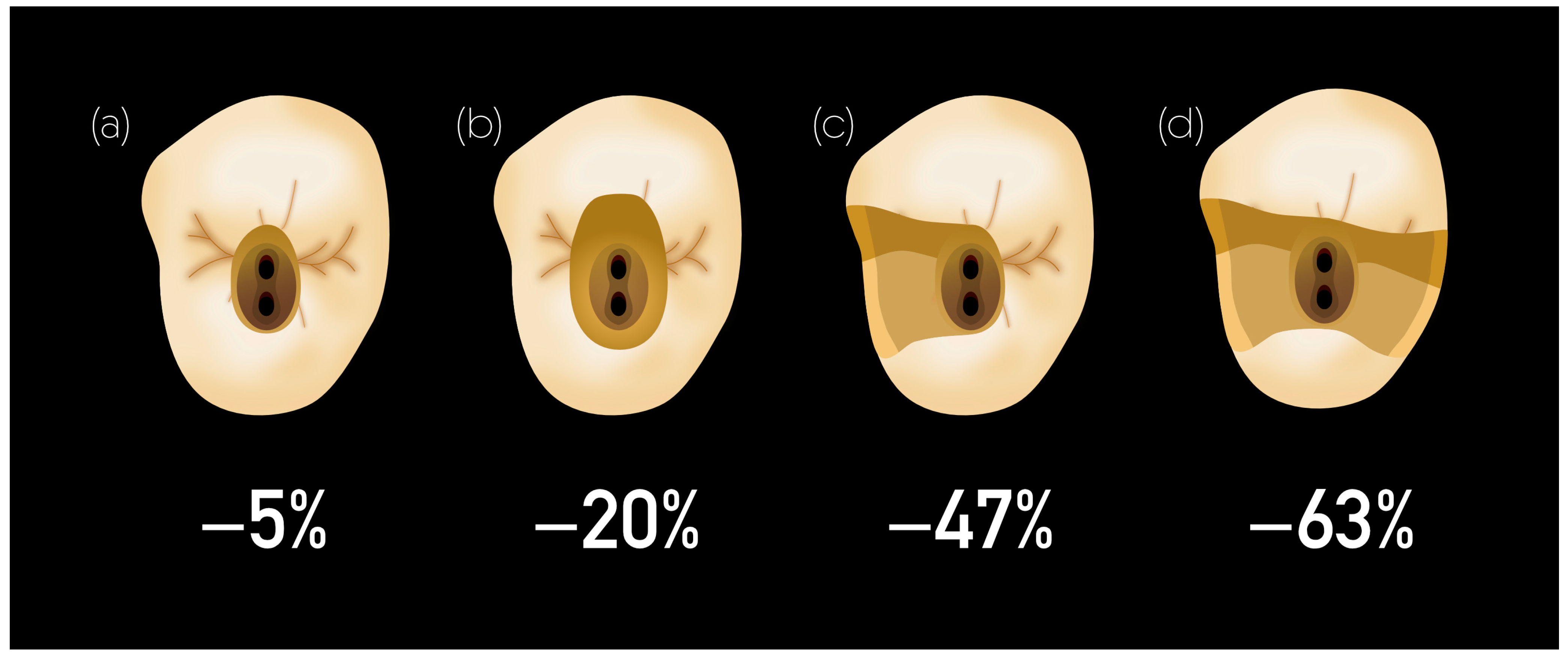 Materials | Free Full-Text | Advanced Material Strategy for Restoring  Damaged Endodontically Treated Teeth: A Comprehensive Review