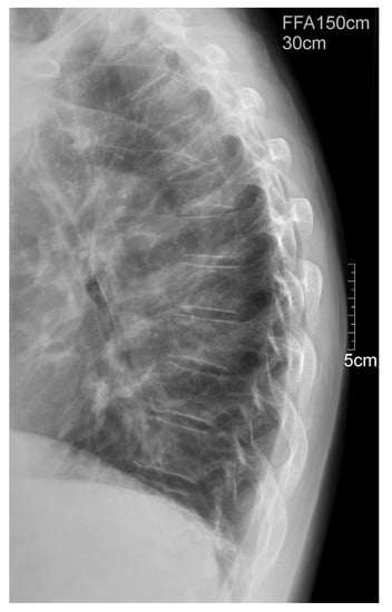 Medicina Free Full Text Pathologic fracture of the thoracic