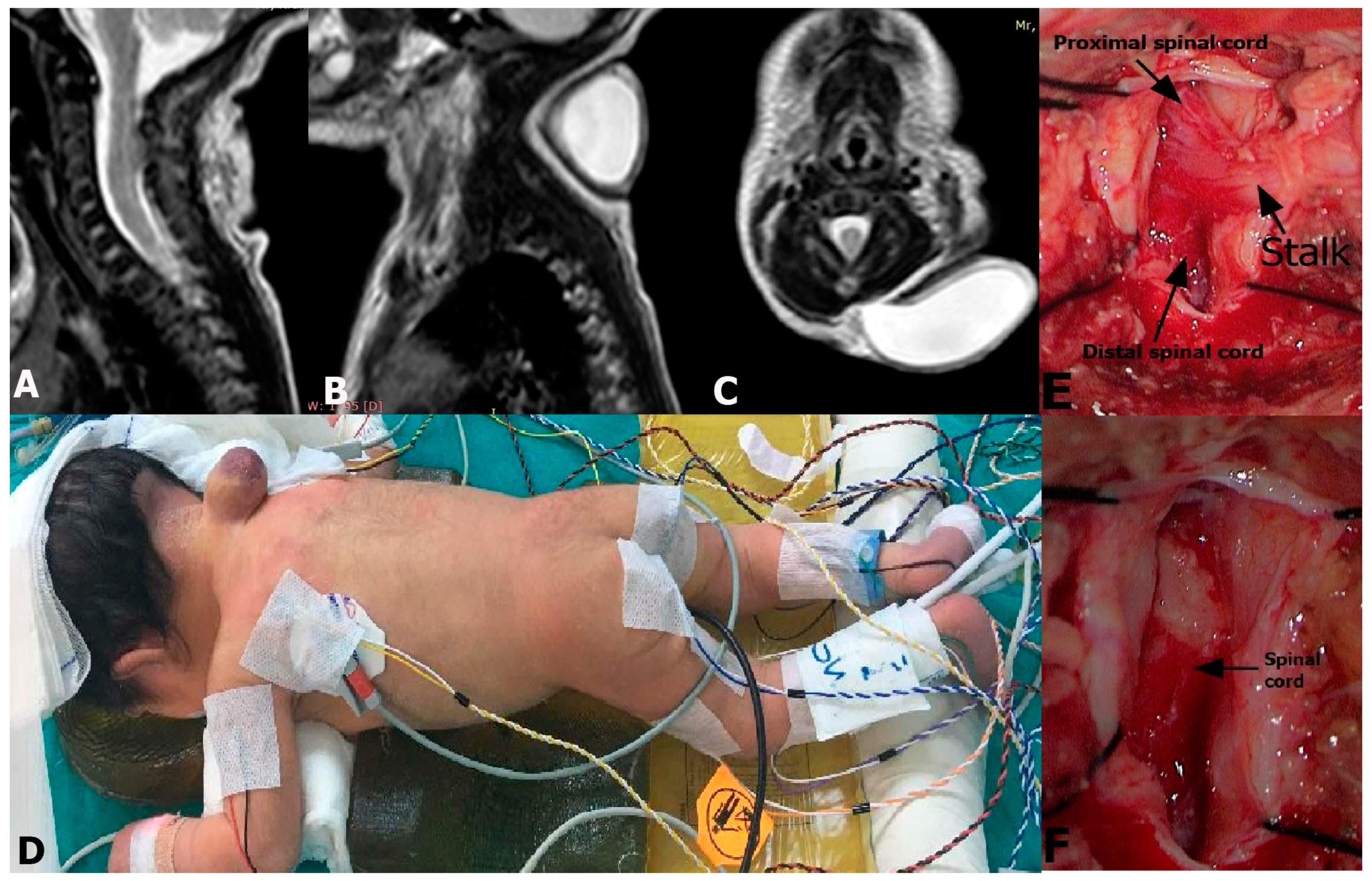 Medicina | Free Full-Text | Limited Dorsal Myeloschisis with and without  Type I Split Cord Malformation: Report of 3 Cases and Surgical Nuances