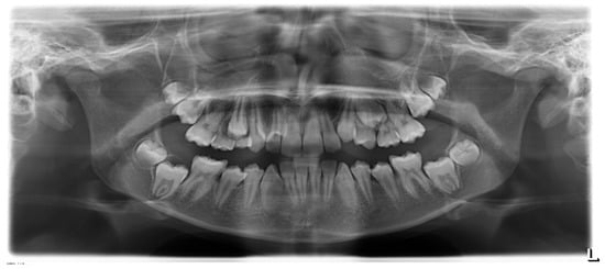 Medicina Free Full Text How To Manage Impacted Third Molars Germectomy Or Delayed Removal A Systematic Literature Review Html