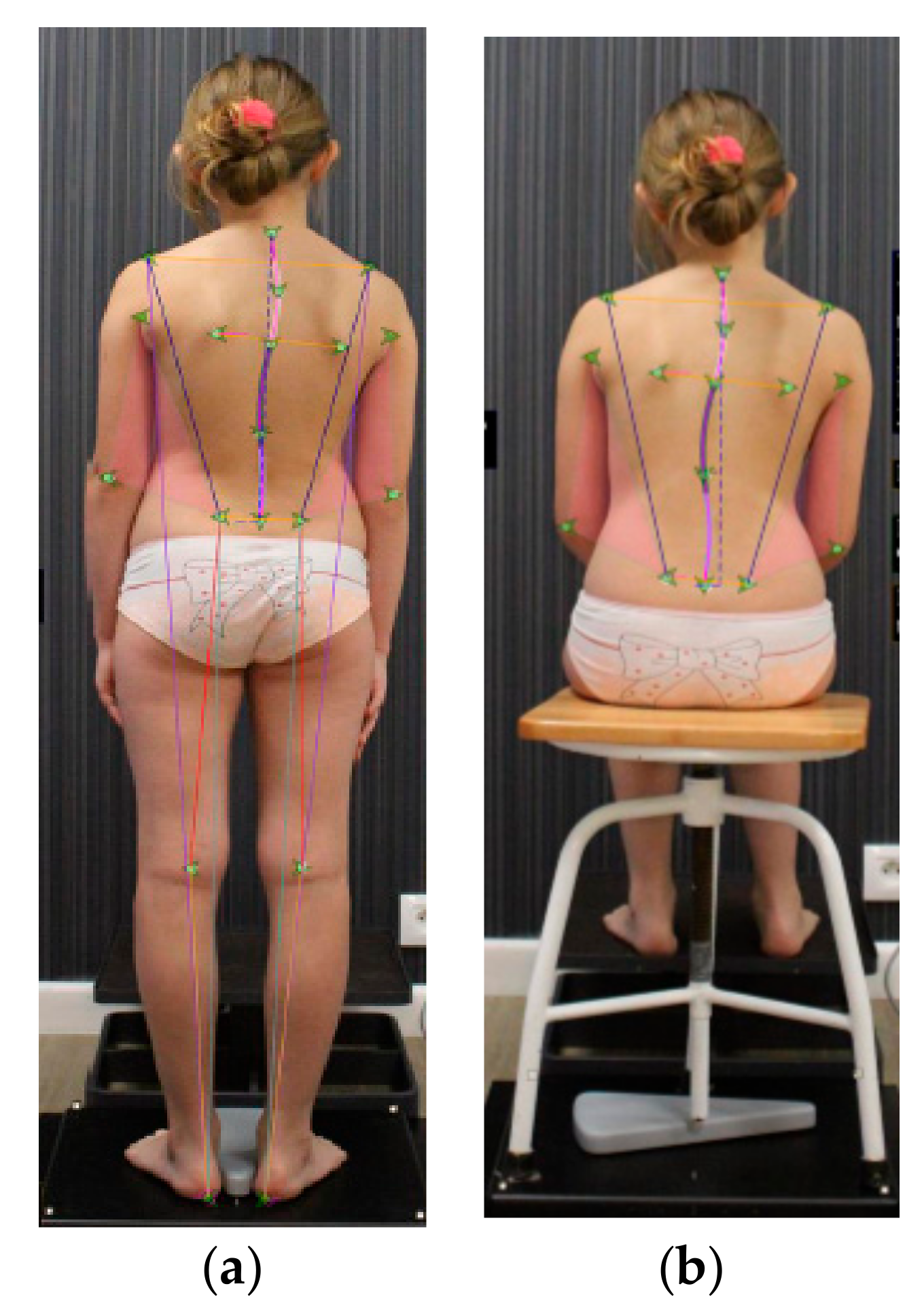 Levoconvex rotatory scoliosis