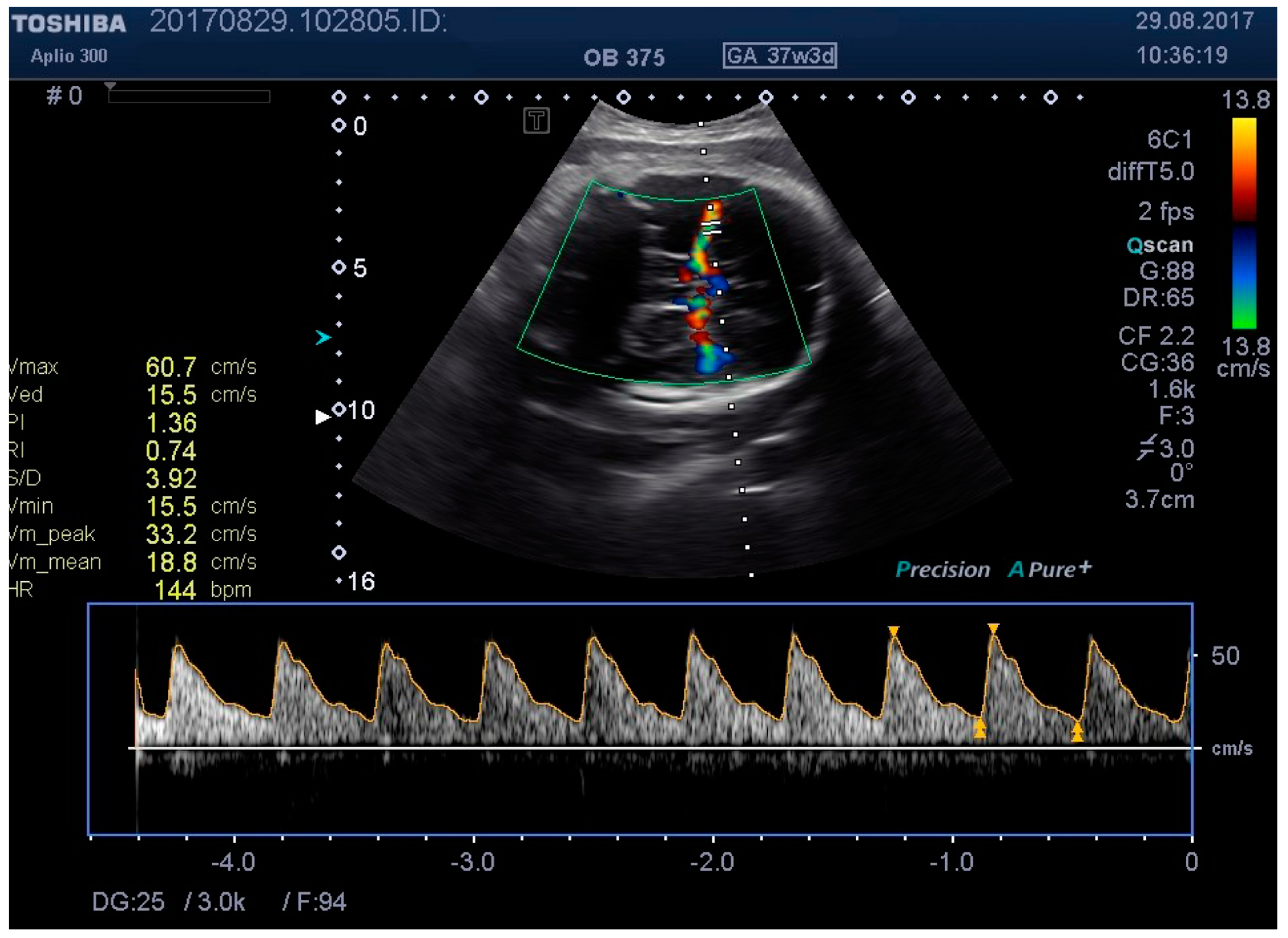 Medicina | Free Full-Text | Ultrasound Probe Pressure on the Maternal  Abdominal Wall and the Effect on Fetal Middle Cerebral Artery Doppler  Indices