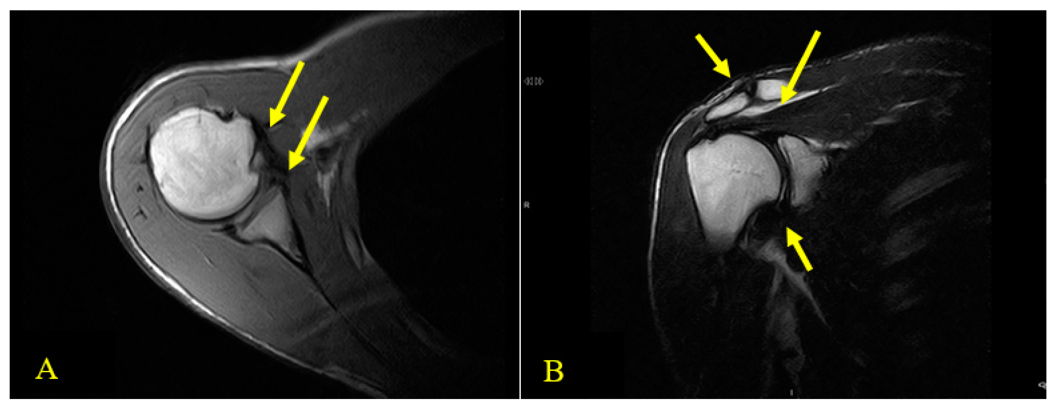 Rotator Cuff Injury: Practice Essentials, Epidemiology, Functional Anatomy