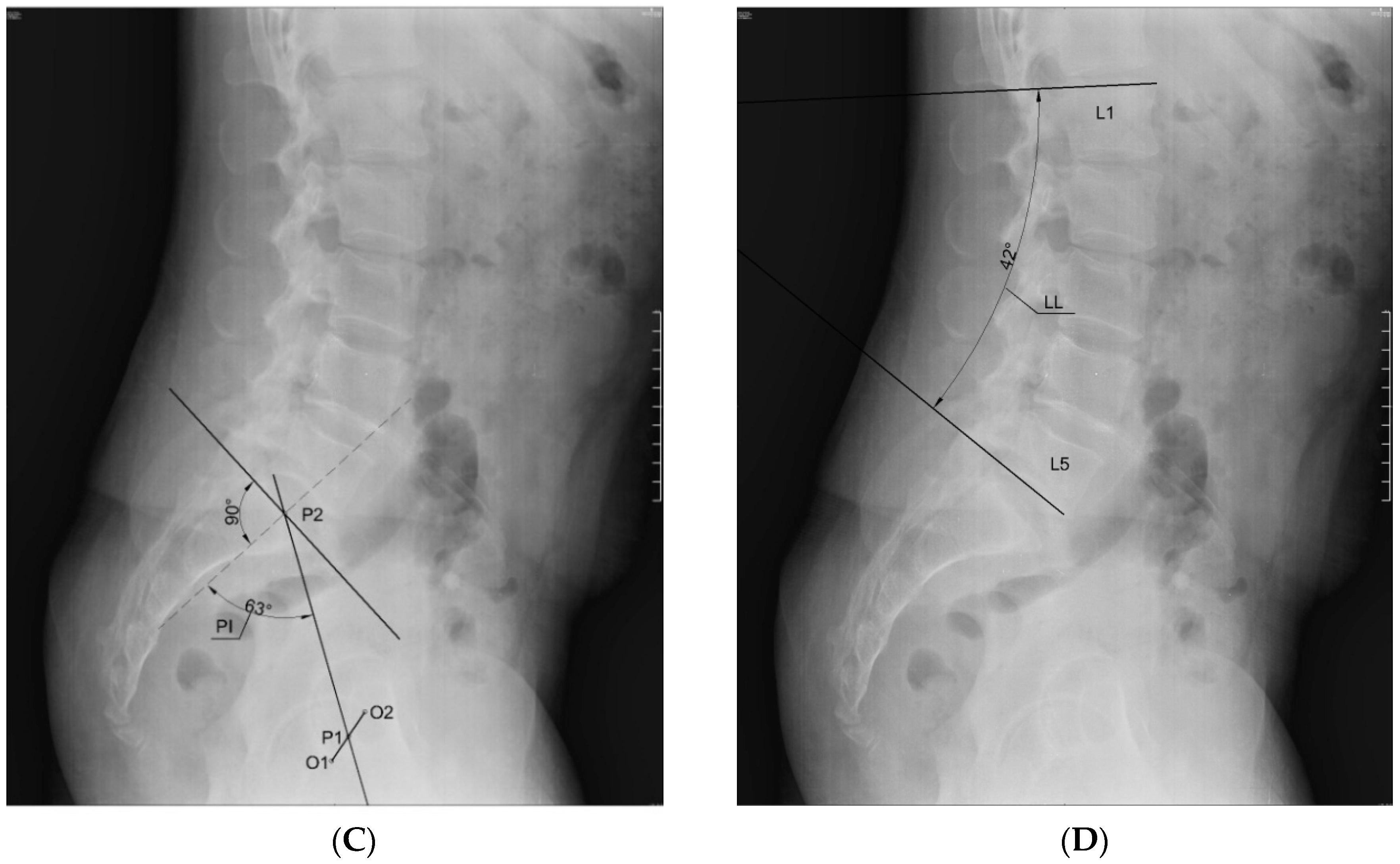 Movement of the pelvis in (A) the sagittal plane, (B) the frontal