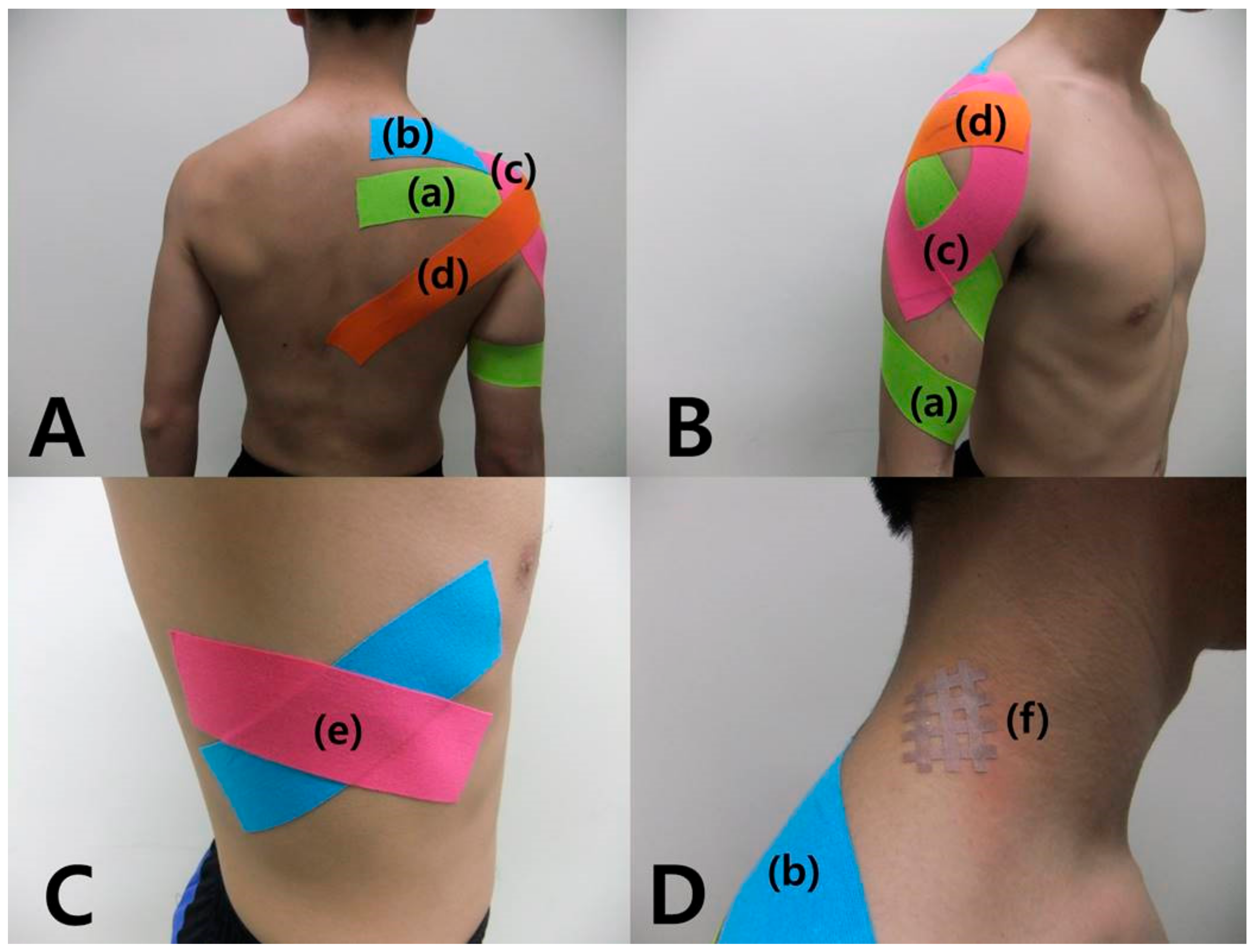 Medicina | Free Full-Text | Effect of Balance Taping Using Kinesiology Tape  and Cross Taping on Shoulder Impingement Syndrome: A Case Report | HTML