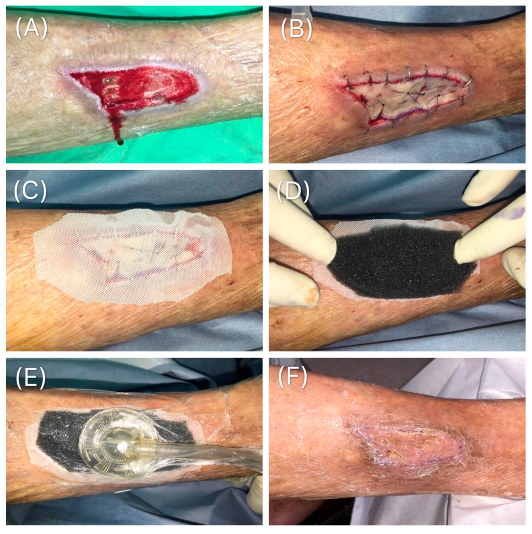 Medicina | Free Full-Text | Retrospective Study on the Clinical Superiority  of the Vacuum-Assisted Closure System with a Silicon-Based Dressing over  the Conventional Tie-over Bolster Technique in Skin Graft Fixation